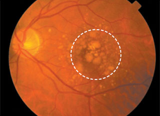 Retina with Dry ARMD (Age-Related Macular Degeneration)