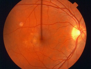 Retina with Wet ARMD(Age-Related Macular Degeneration)