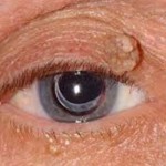 Eyelid Cancers and Benign Growths