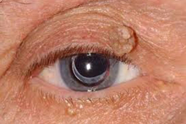 patient displaying skin growth on upper eyelid, cancer or benign growth