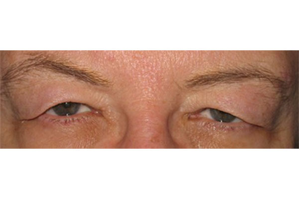 patient eyes with drooping lids showing need for upper blepharoplasty