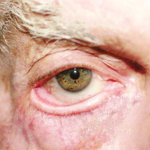 ectropion and entropion eye conditions appears red and droopy