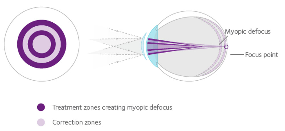 MiSight Contact Lenses