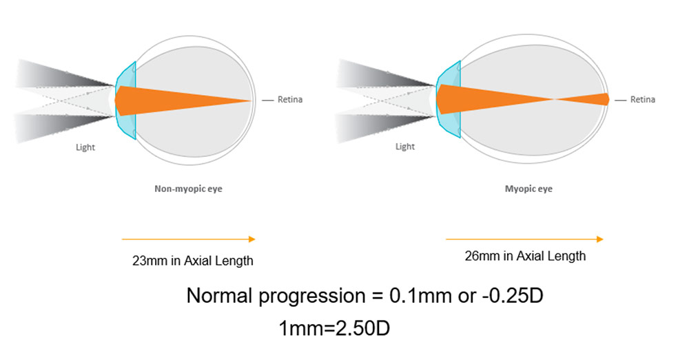 Myopia Management